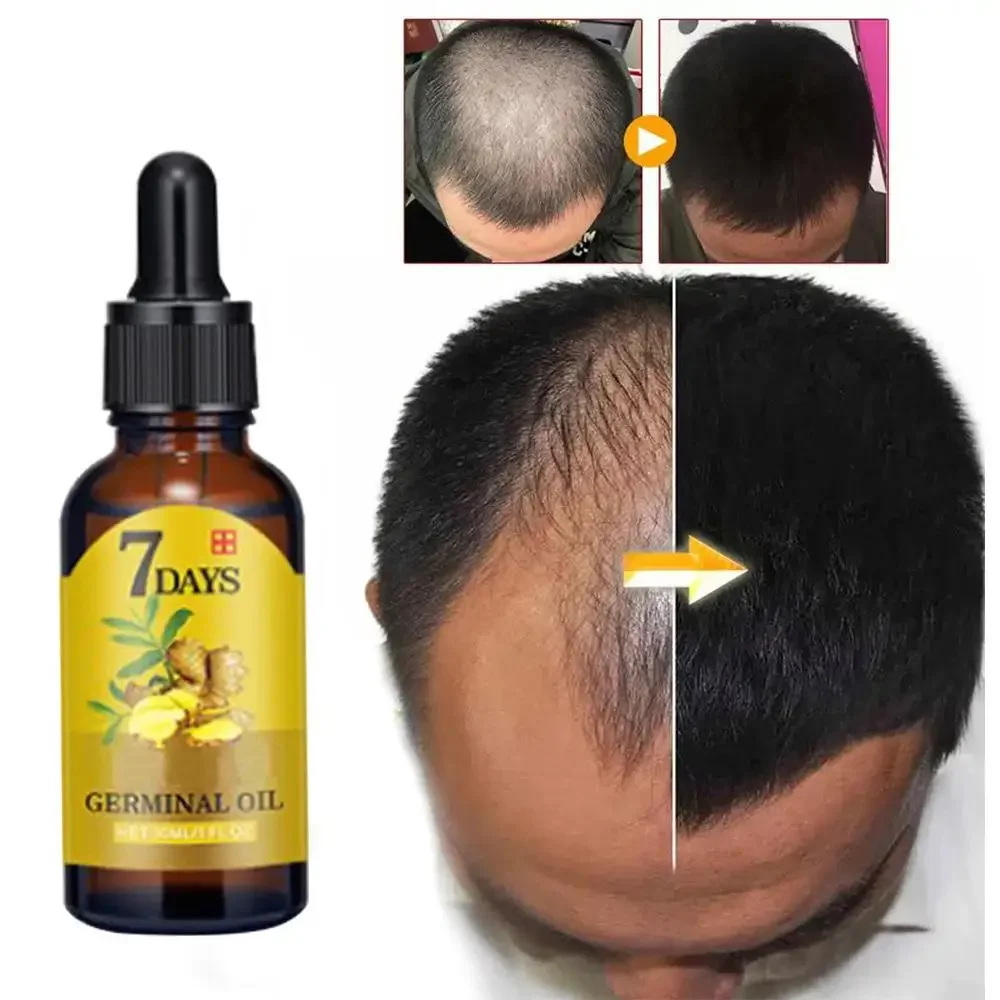 Hair Care Essence Oil Spray - 育毛ジンジャー高速成長髪エッセンシャルオイルヘアケア損失防止オイル頭皮トリートメント男性女性ダメージヘア